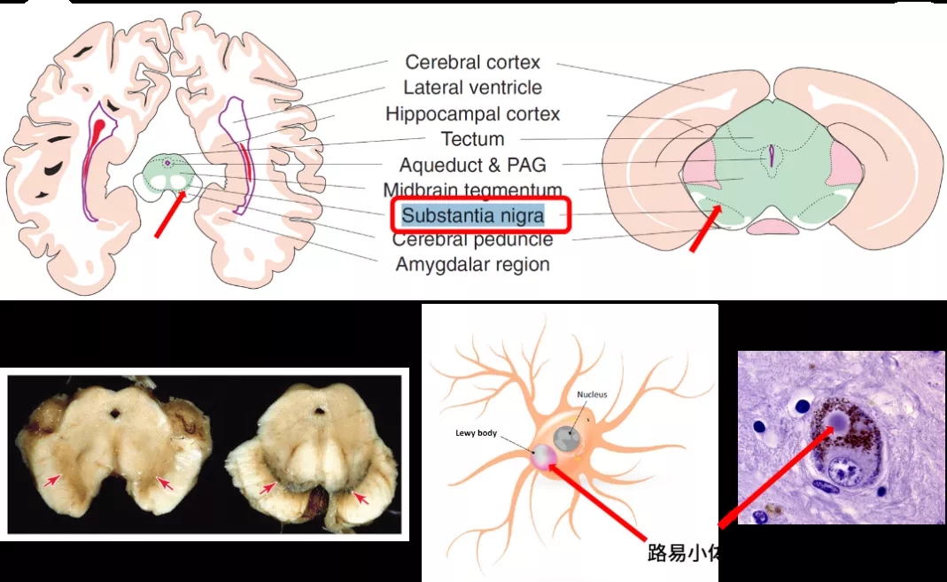 图1. 中脑黑质是PD的病灶