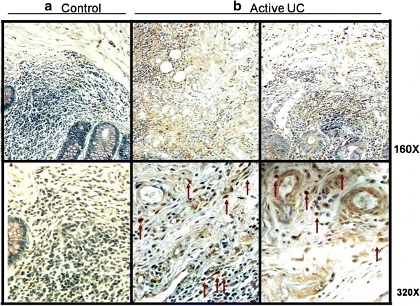 图2 UC患者结肠粘膜中IL-10蛋白的表达.png