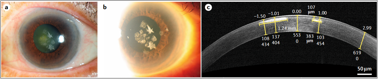 B6-hTGFBI人源化小鼠助力角膜营养不良症（CD）研究