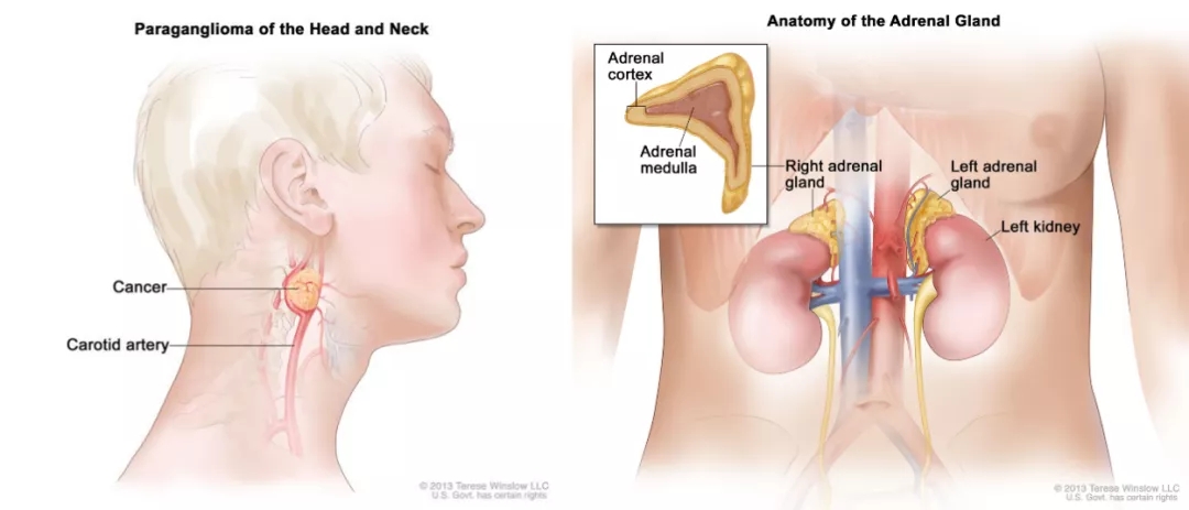 图1. 副神经节瘤和嗜铬细胞瘤[1]