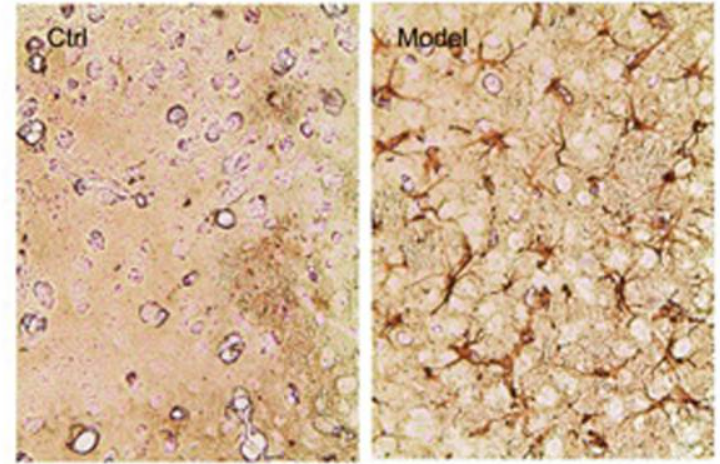 帕金森症 帕金森症