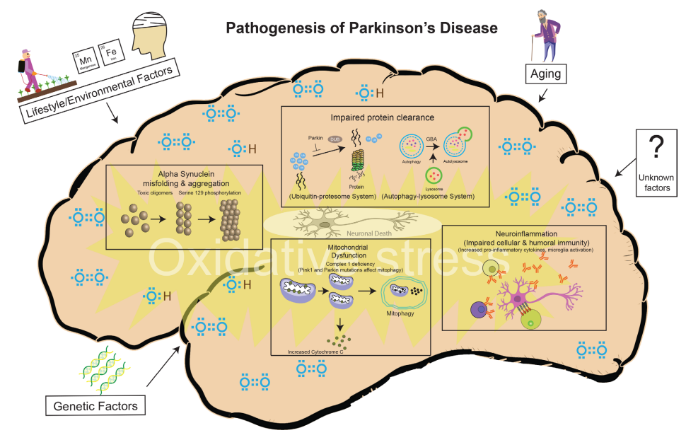 帕金森症 帕金森症