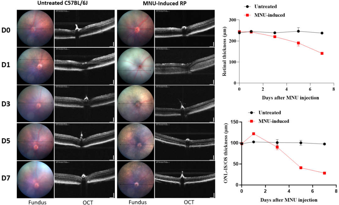 视网膜色素变性