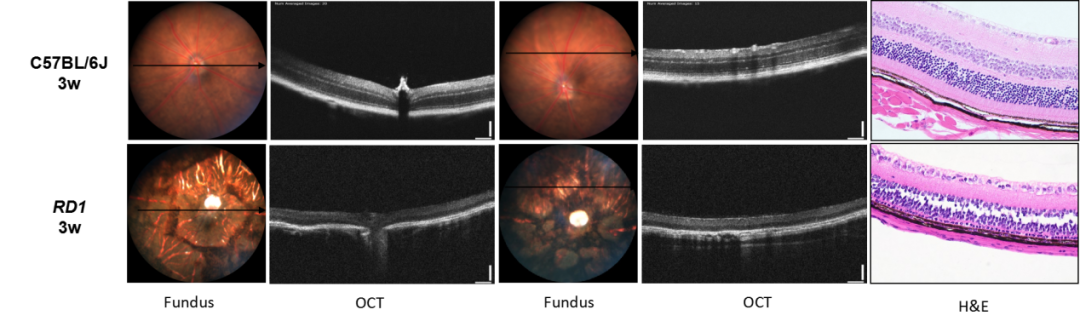 视网膜色素变性