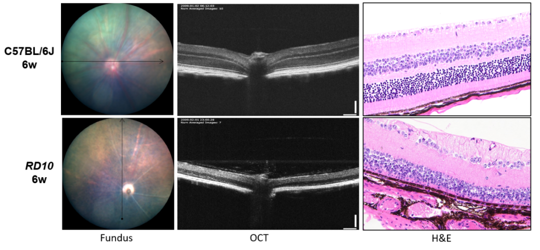视网膜色素变性