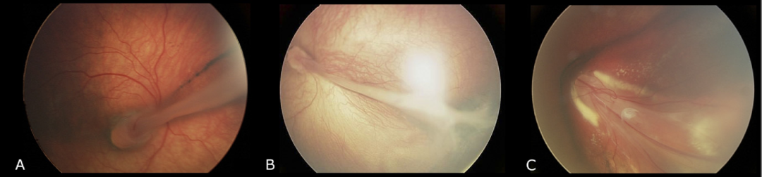 家族性渗出性玻璃体视网膜病变
