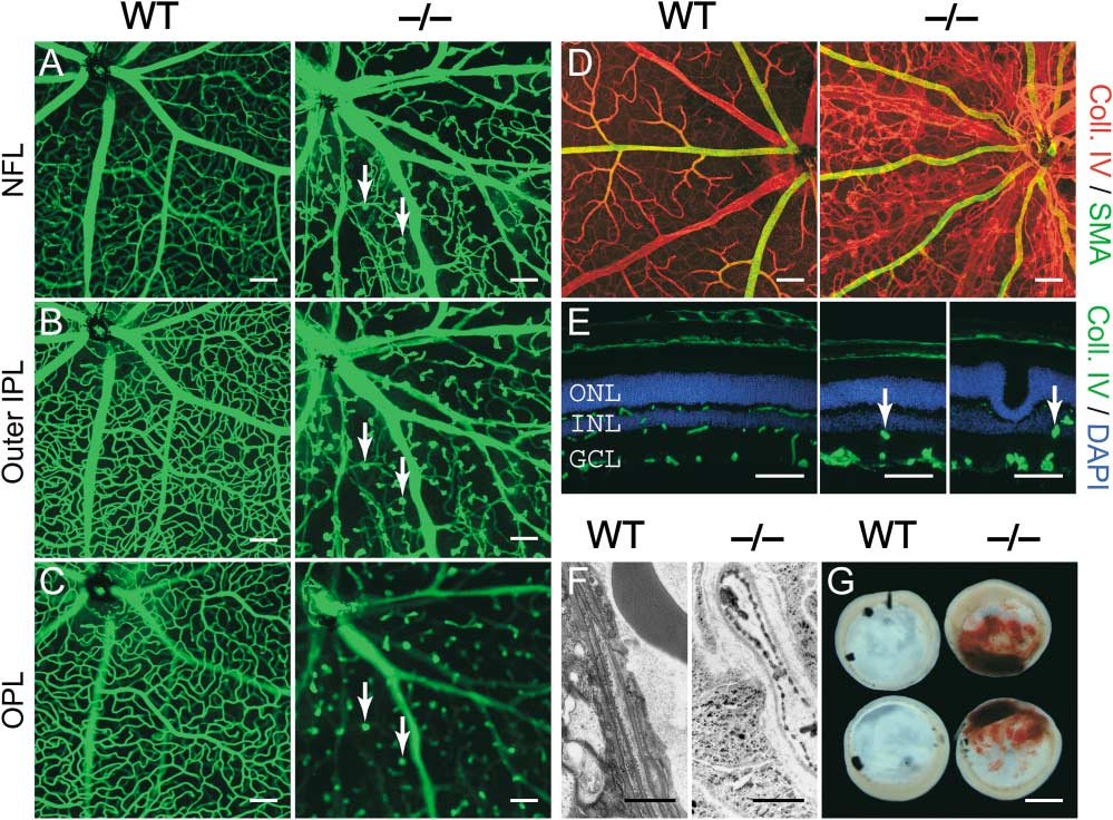 家族性渗出性玻璃体视网膜病变