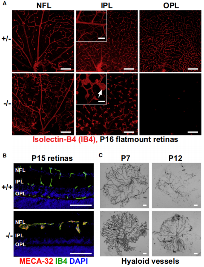 家族性渗出性玻璃体视网膜病变