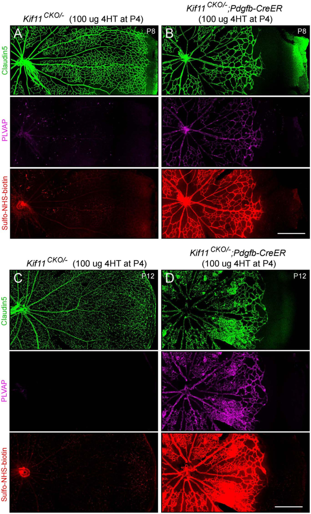 家族性渗出性玻璃体视网膜病变