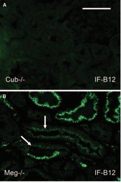 维生素B12选择性 吸收障碍综合征