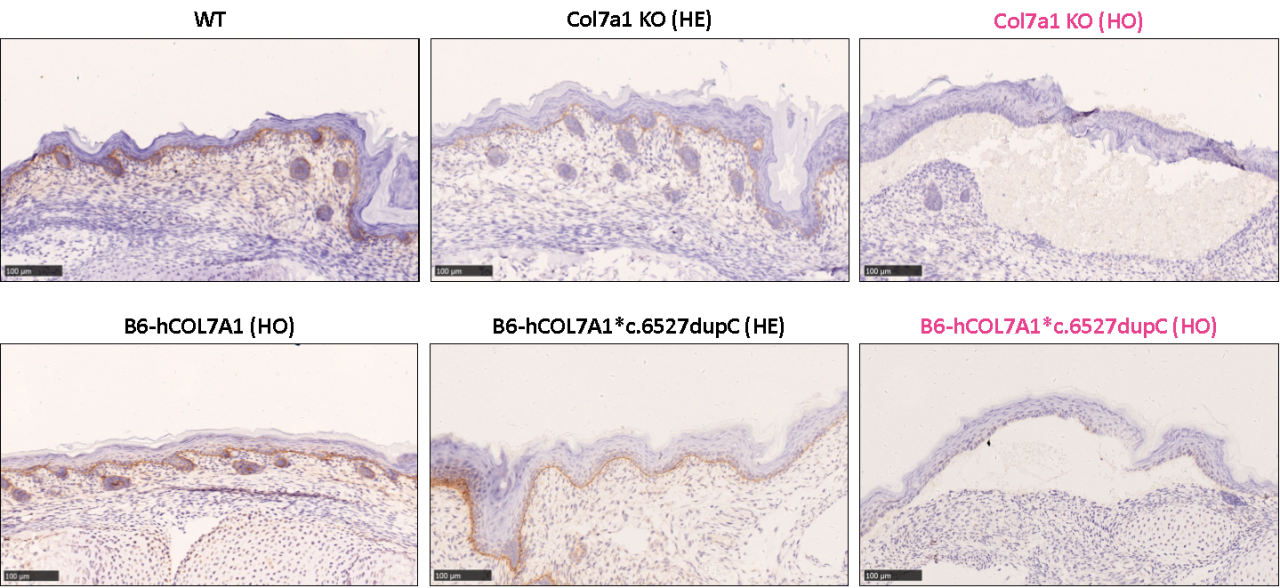 营养不良性大疱性表皮松解症(DEB)研究新模型 营养不良性大疱性表皮松解症(DEB)研究新模型