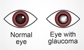 青光眼——造成不可逆伤害的隐形视力“杀手”