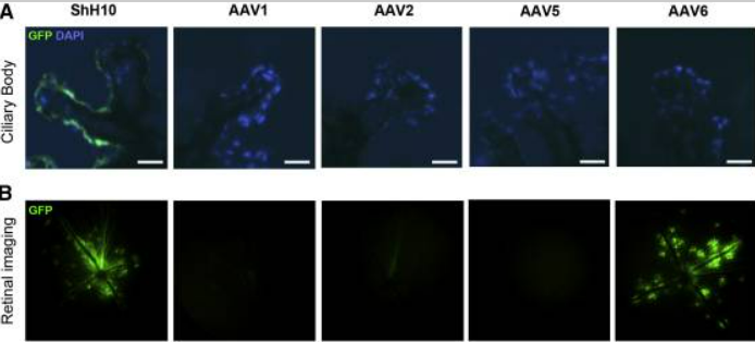 青光眼——造成不可逆伤害的隐形视力“杀手”
