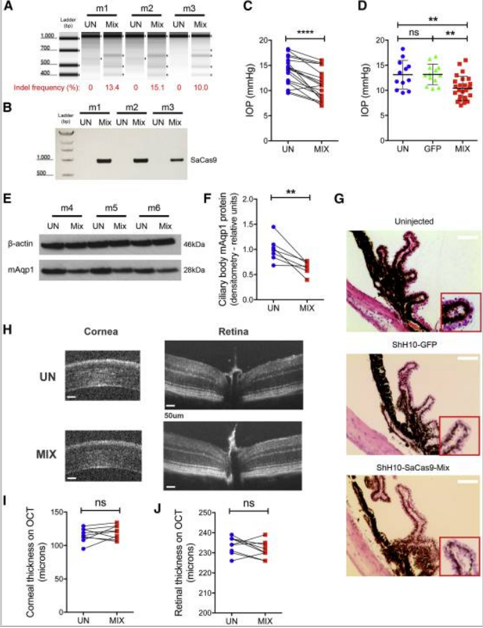 青光眼——造成不可逆伤害的隐形视力“杀手”