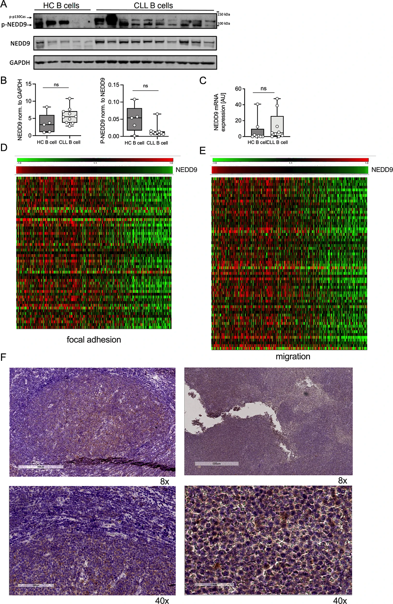 NEDD9在淋巴细胞白血病中作用