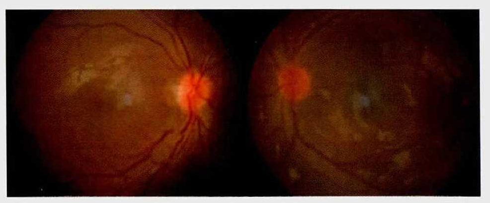 Leber遗传性视神经病变诊断与治疗