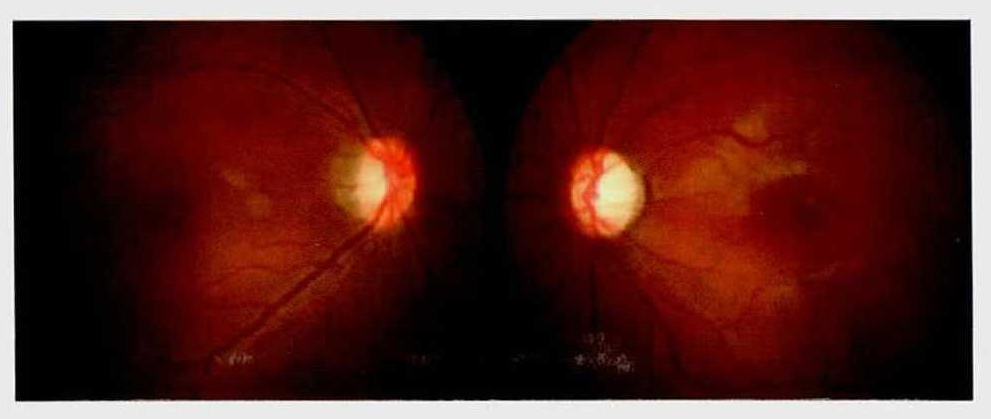 Leber遗传性视神经病变的诊断与治疗