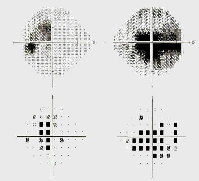 Leber遗传性视神经病变的诊断与治疗