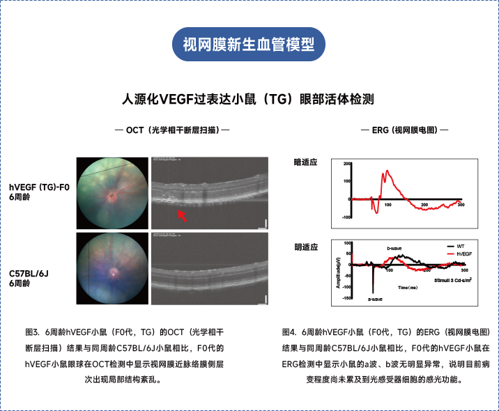 年龄相关性黄斑变性