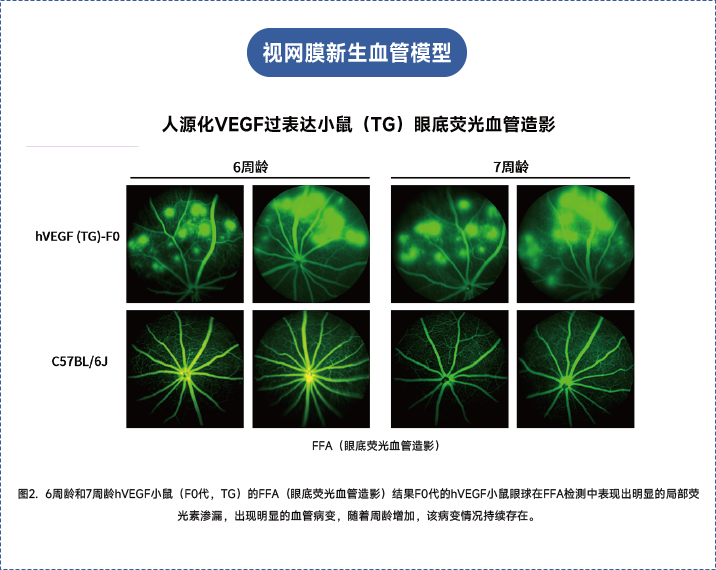 年龄相关性黄斑变性