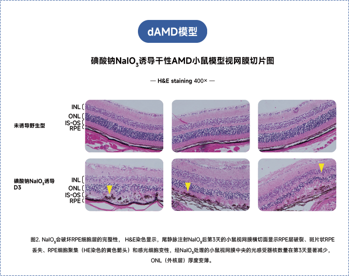年龄相关性黄斑变性