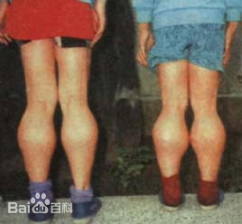 杜氏肌营养不良