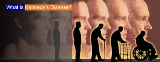 肯尼迪病(KD)