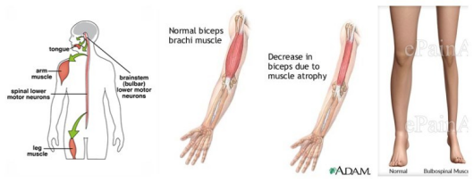 肯尼迪病(KD)——机理研究 肯尼迪病(KD)——机理研究