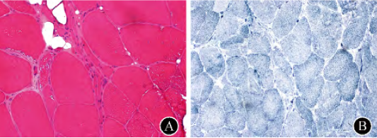 肯尼迪病(KD)——机理研究 肯尼迪病(KD)——机理研究