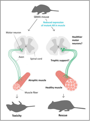 肯尼迪病(KD)——机理研究