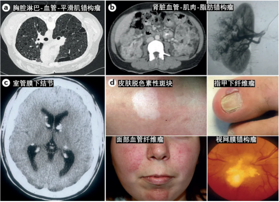 结节性硬化症 结节性硬化症