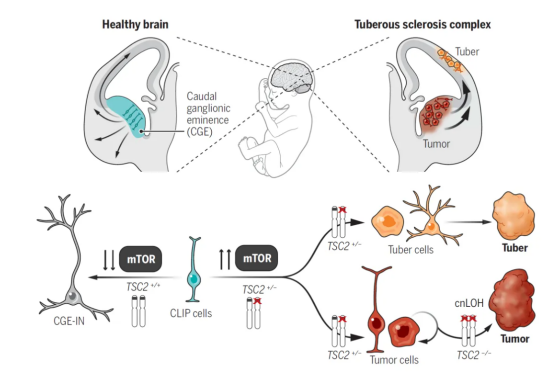 结节性硬化症 结节性硬化症