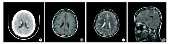 结节性硬化症 结节性硬化症