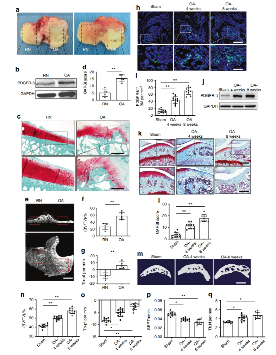 PDGFR-β通过增加依赖于H型血管的异常软骨下骨生成促进骨关节炎