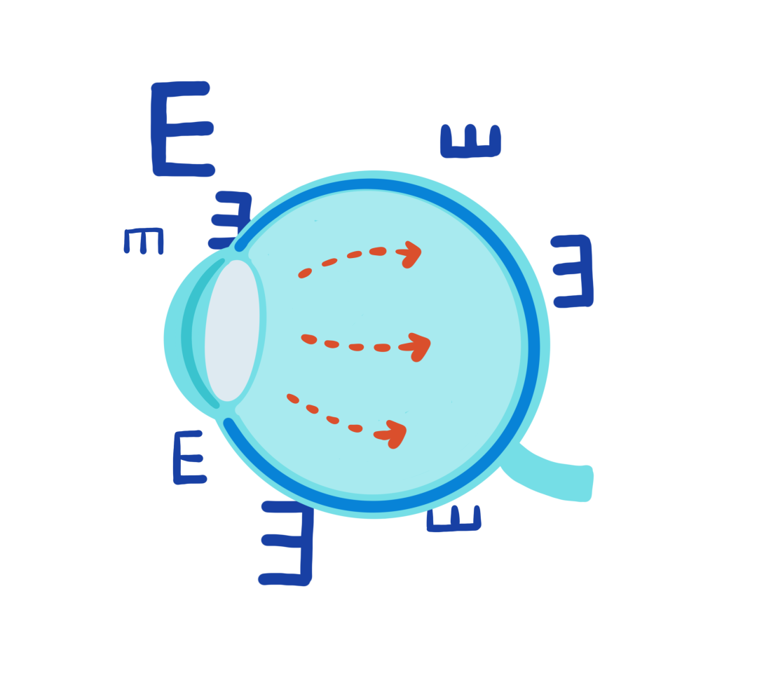 “致盲眼病”青光眼的临床前研究进展